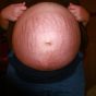 Things to Know When Dealing With Stretch Marks